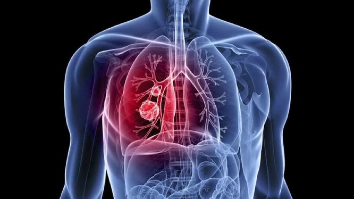 Ο «οδικός χάρτης» ενός ασθενούς με καρκίνο του πνεύμονα